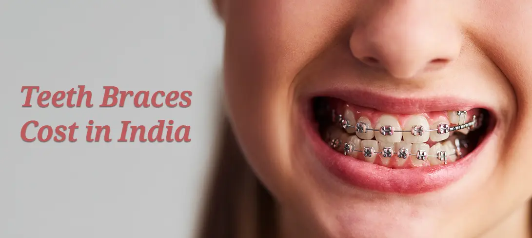 teeth-braces-cost-in-india